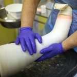 الذكاء الاصطناعي في تشخيص الكسور: ثورة طبية تطلق تجربة NHS لتحسين دقة وكفاءة علاج الإصابات